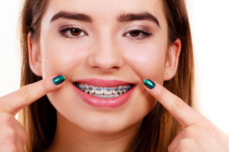 Braces Orthodontist Cape Town