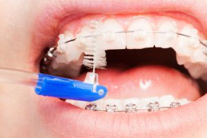 Expert Orthodontist in Cape Town - Walton Orthodontics