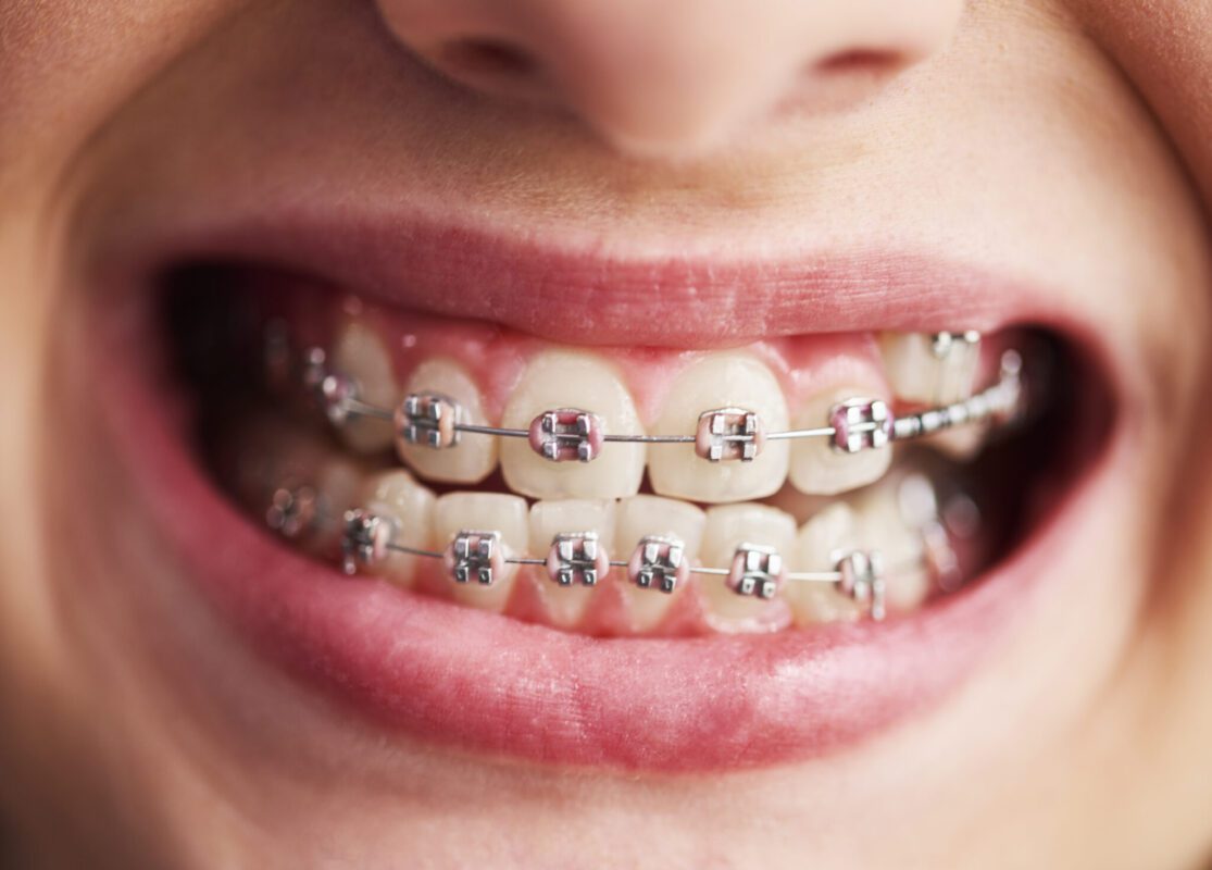 Metal/ceramic braces & Aligners in Tokai