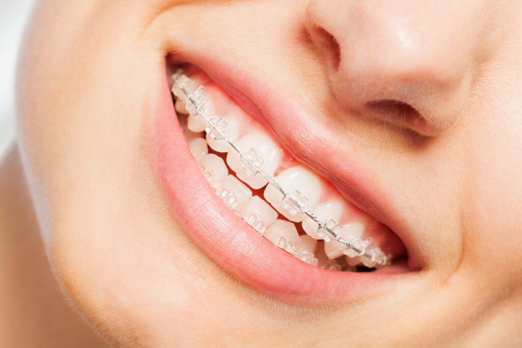 Ceramic Braces: A Clear Choice for a Confident Smile