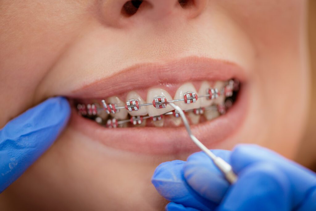 How Long Do Braces Need to Stay On? A Complete Guide